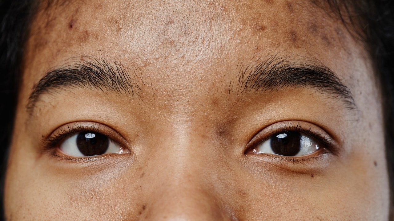 "Second Puberty” Could Be Causing Your Adult Acne, Dermatologists Explain Why