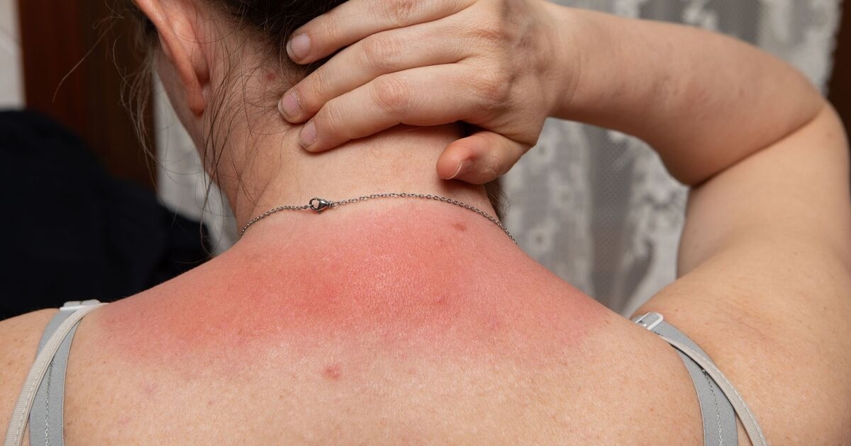 Consejo curioso sobre la compresa menstrual de 1 penique que puede aliviar el dolor de las quemaduras solares