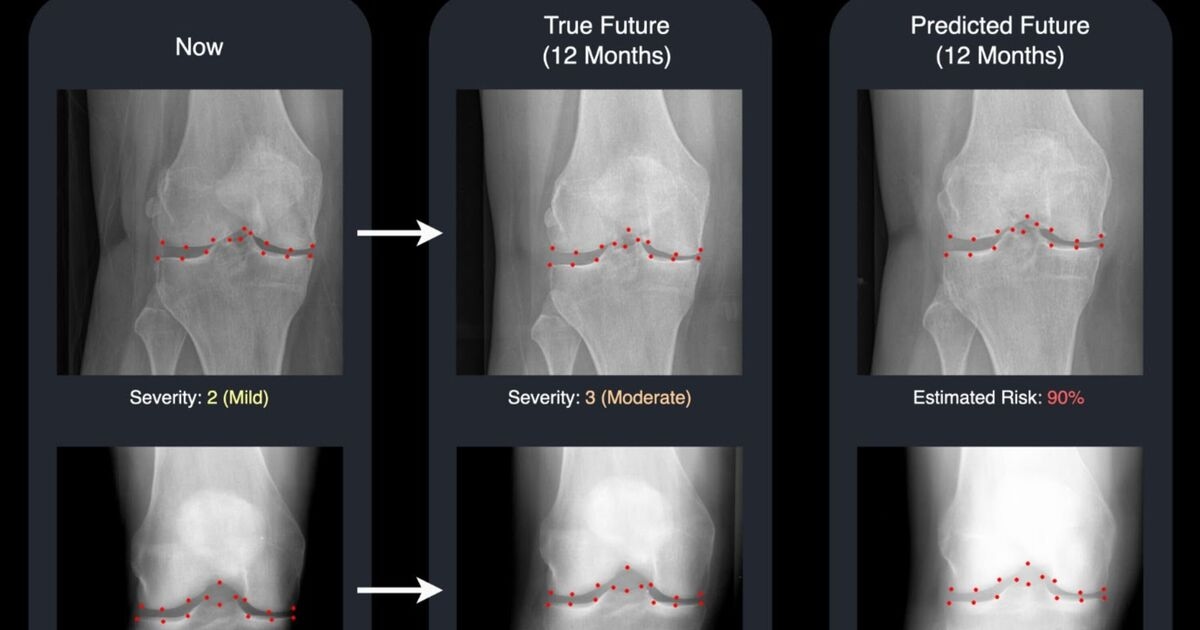 Osteoarthritis breakthrough as incredible new tech can predict patients' future X-rays