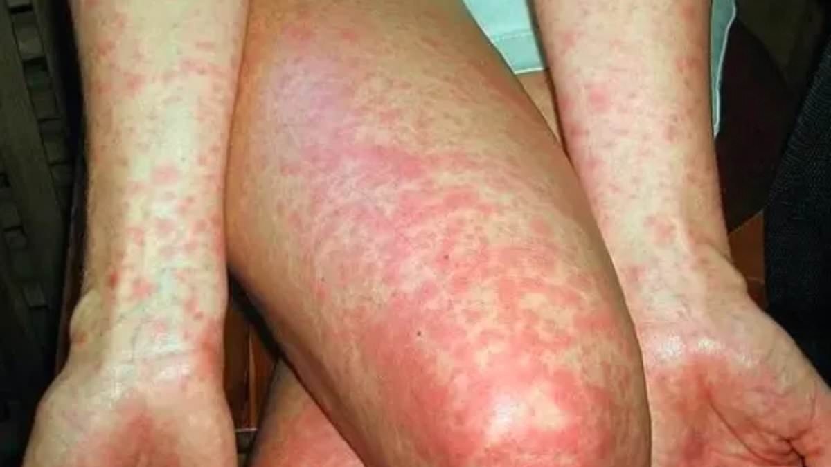 Alerta urgente: estado australiano registra sexto caso de doença mortal neste ano