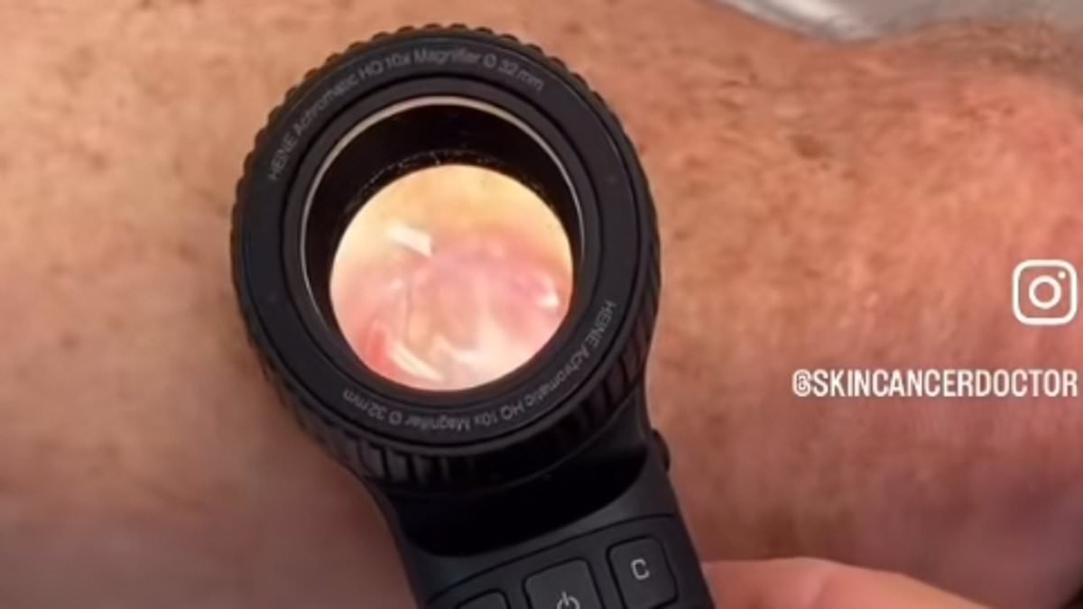 Un médico especializado en cáncer de piel comparte un impactante video del "peor melanoma" que ha visto: "No siempre parecen lunares".