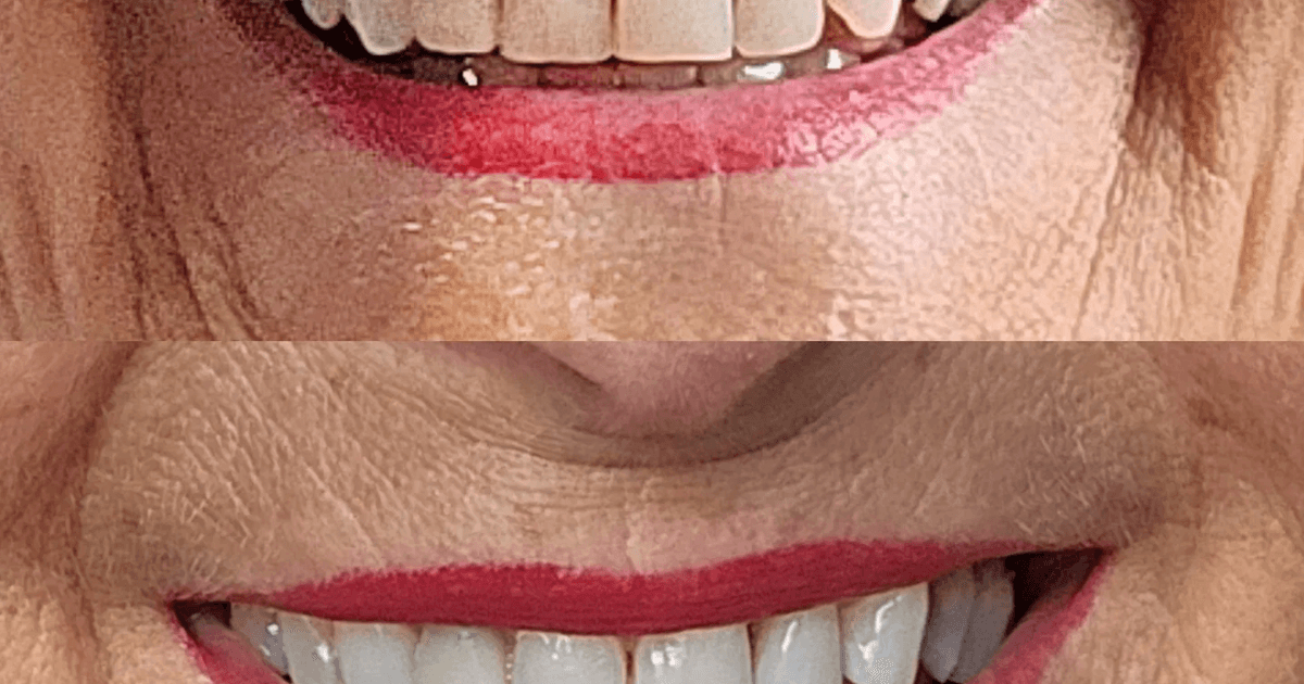 Il kit sbiancante per denti che ha reso il sorriso di un 77enne "fantastico" è scontato del 20%