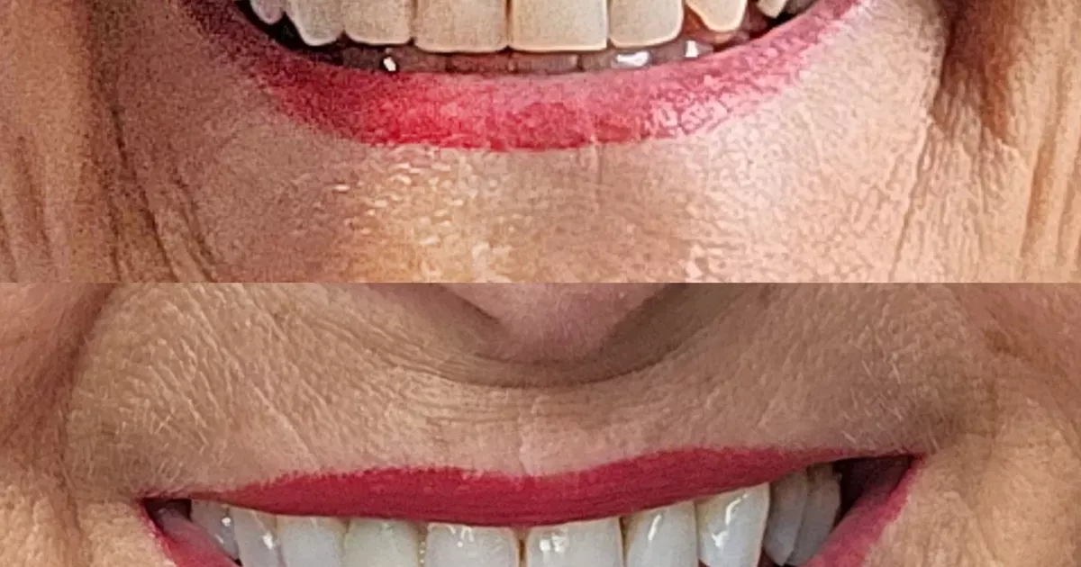 Il kit sbiancante per denti che ha reso il sorriso di un 77enne "fantastico" è scontato del 20%