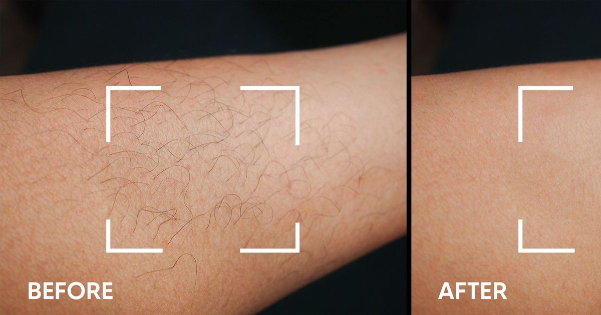'Painless' hair removal device that works in 'weeks' and saves on waxing is £140 off