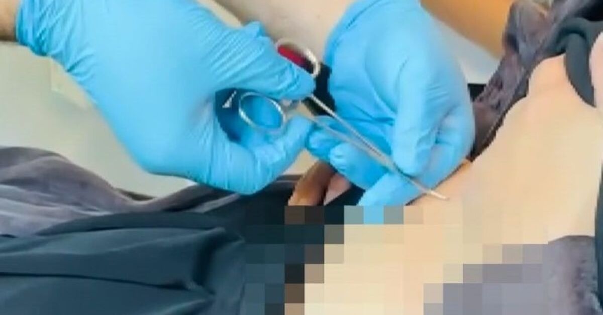 Fue al hospital quejándose de debilidad. ¡Le salió una garrapata del estómago!