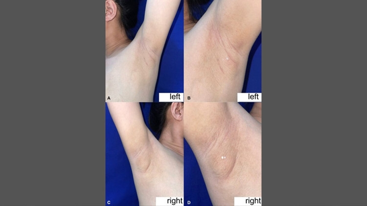 Filipijnse vrouw lekt melk uit haar oksel: wat is de oorzaak van deze zeldzame aandoening?