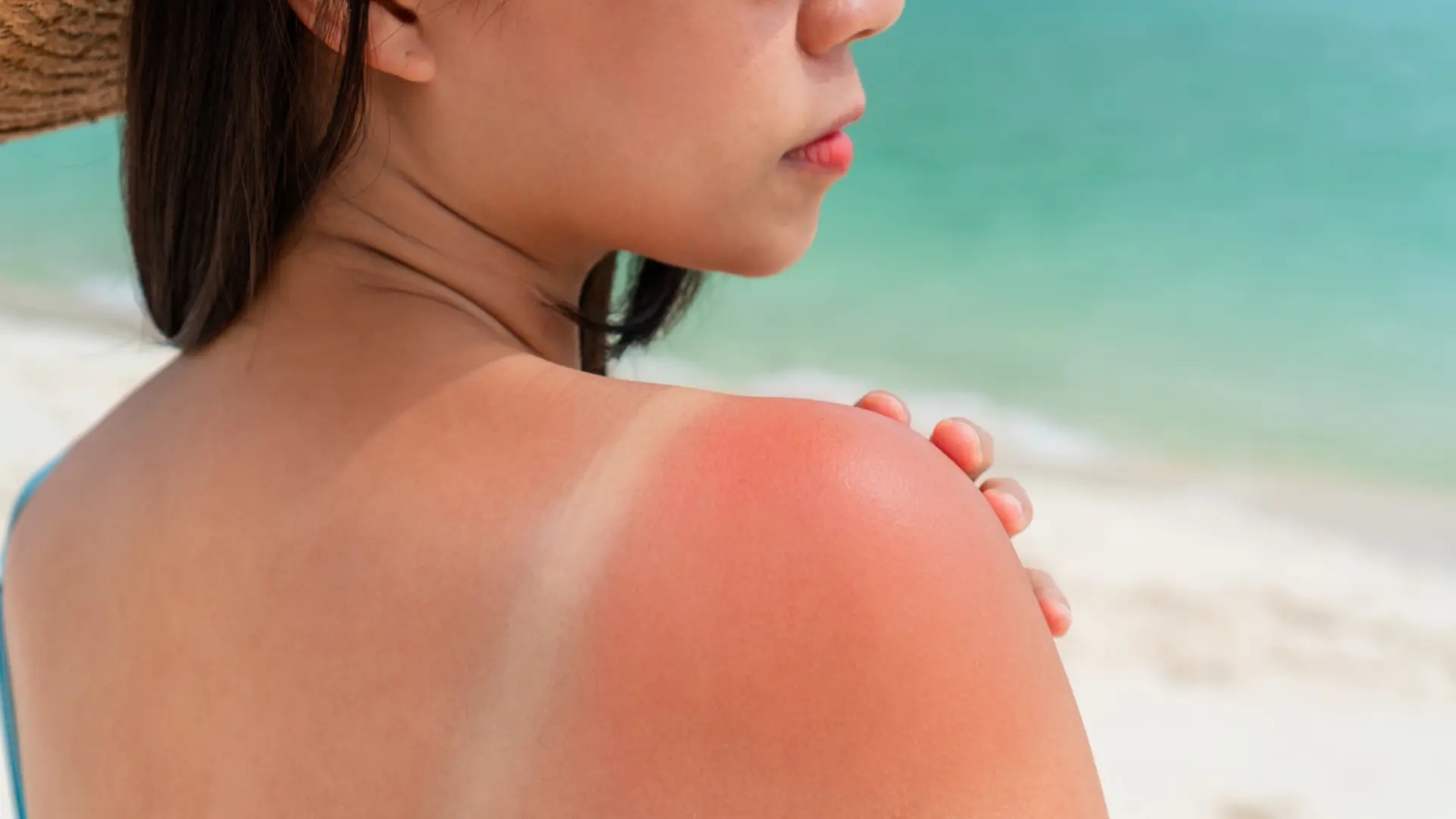 Cinque modi per curare più velocemente le scottature solari, secondo un dermatologo