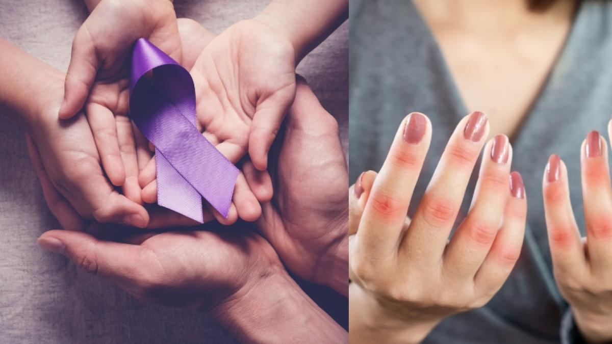Lupus-Patienten berichten, wie es ist, mit dieser stillen und schwer zu diagnostizierenden Krankheit zu leben.