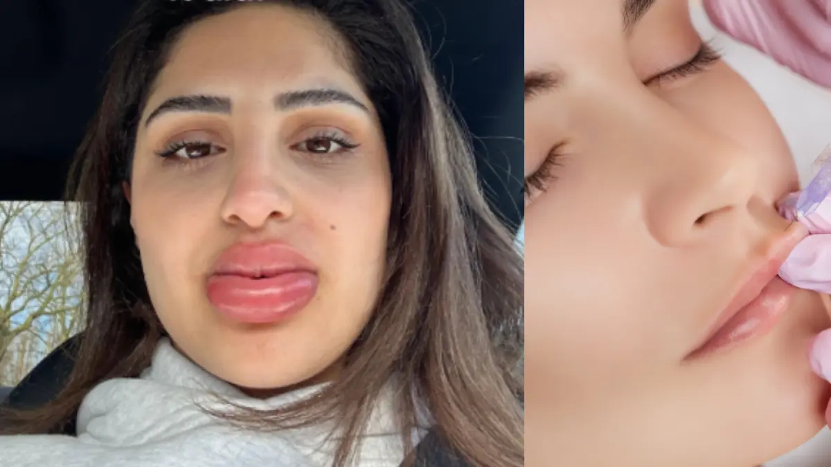 Joven se sometió a tratamiento estético y quedó con ‘el aspecto de una muñeca Bratz’