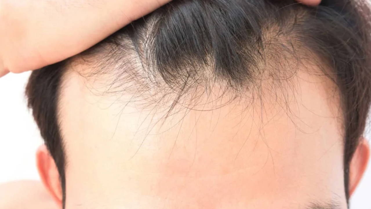 A razão oculta da queda de cabelo: quão eficaz é a deficiência de vitaminas e minerais?