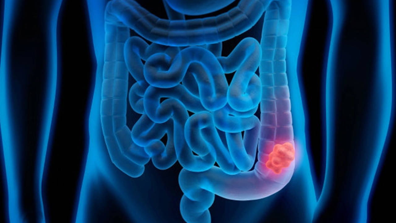 Increase in colon cancer cases: Early diagnosis saves lives