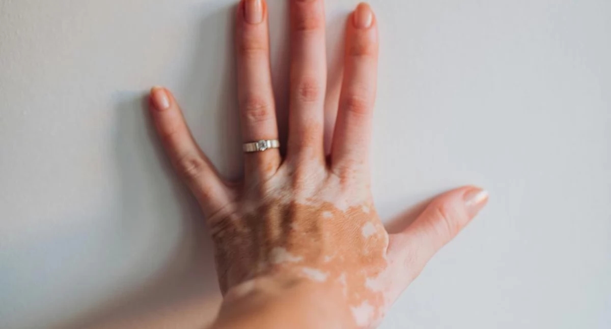Nicotinamide lowers skin cancer risk. New data from an analysis of 33,000 patients.