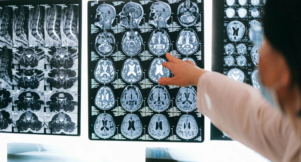 Elle touche de plus en plus de personnes âgées de 30 à 40 ans. La thérapie ciblée contre les gliomes change les règles du jeu et la vie quotidienne des patients.