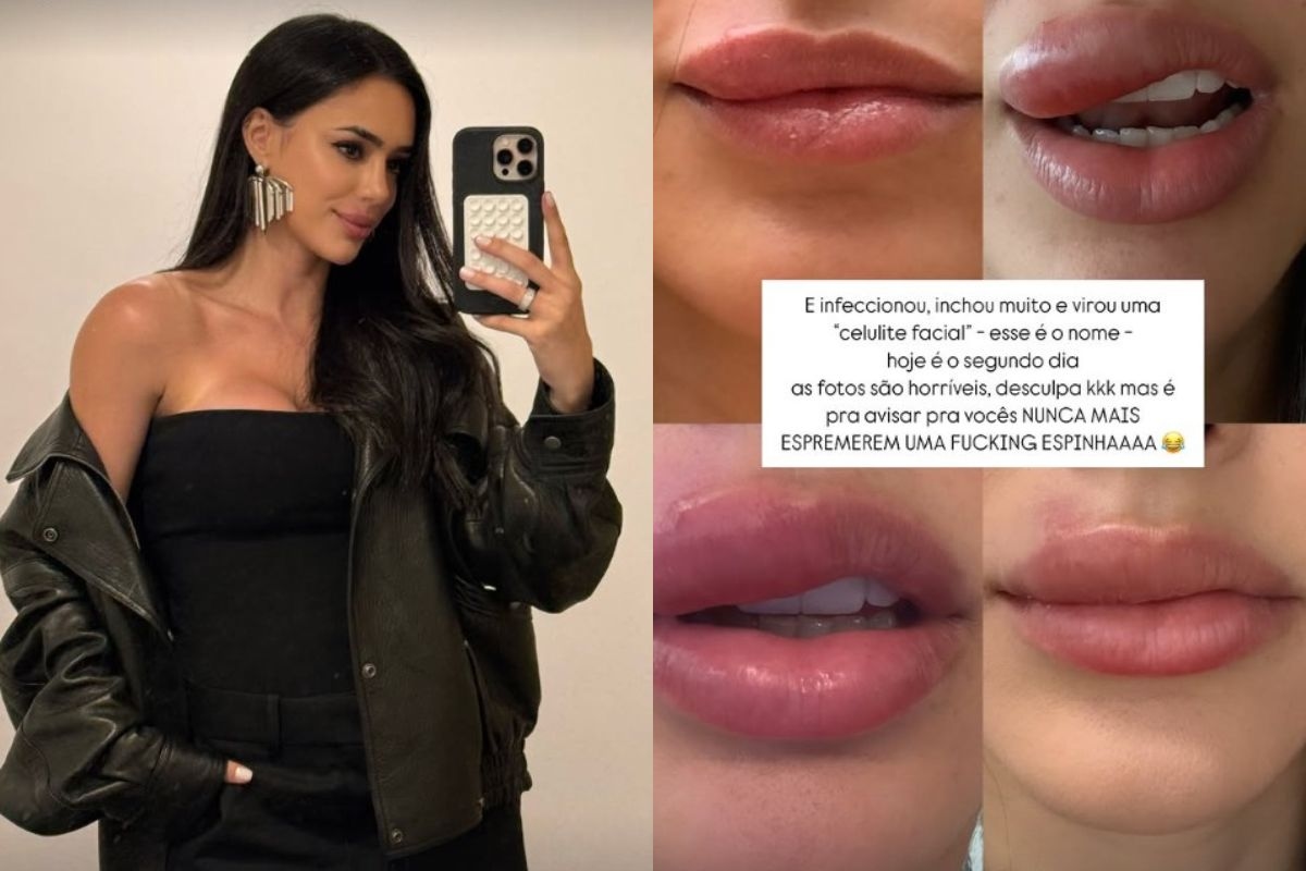 What is facial cellulitis, a serious infection revealed by Bruna Biancardi