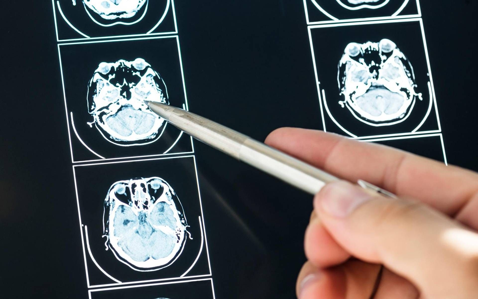 Artificial Intelligence Can Predict Parkinson's Disease Evolution, Italian Study Says