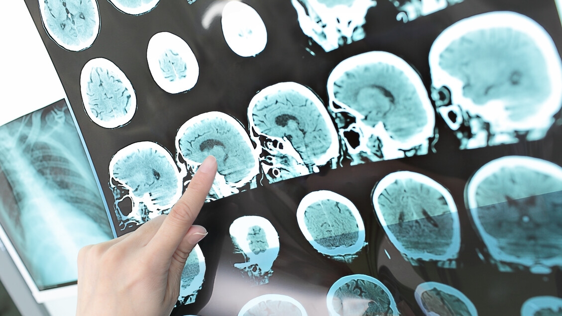 Desde la ISS, directrices para el diagnóstico y tratamiento de 2 efectos del accidente cerebrovascular