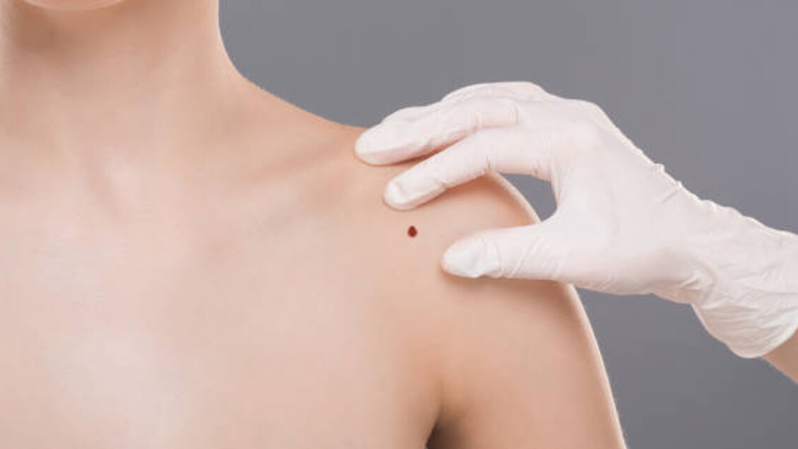 Ben haritalaması ortadan kalkmadı, dermatolojik muayenenin bir parçası.