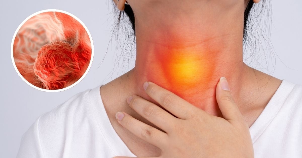 ¿Tienes reflujo y tomas bebidas calientes? Estos son los factores que podrían disparar este cáncer