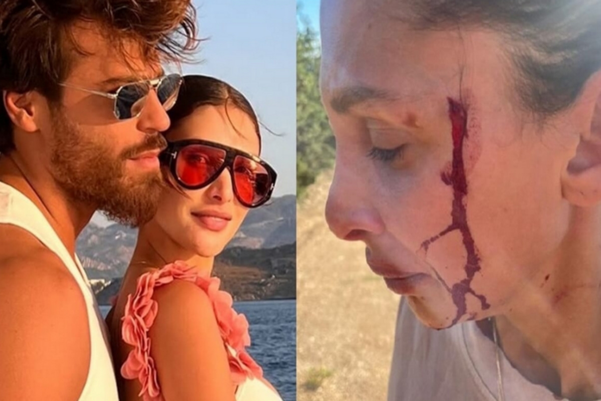 Sara Bluma, Can Yaman's girlfriend, reports her ex's abuse: shocking photo / Can Yaman: "I love you and I will support you."