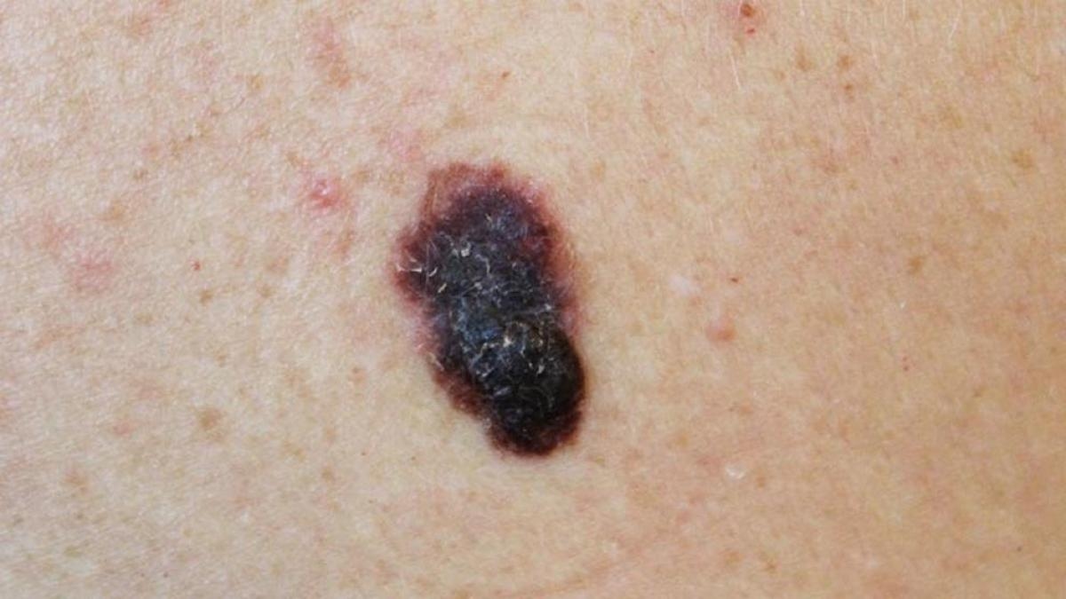 Melanoma: qué es, cómo prevenir y tratar este tipo de cáncer de piel