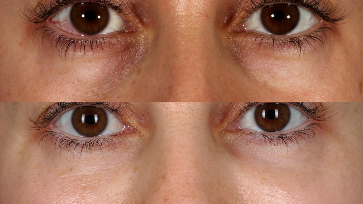 How to correct dark circles with long-lasting results