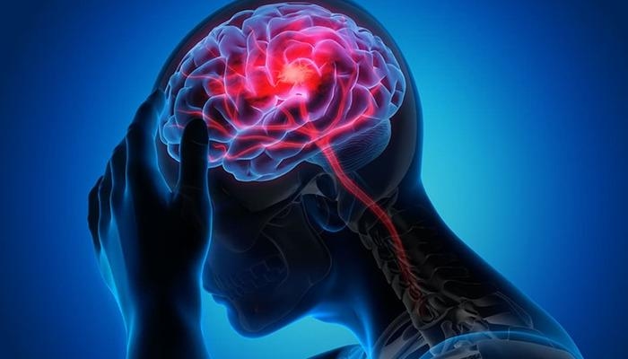 Un neurologue met en garde contre les AVC : « Une intervention précoce permet de prévenir les AVC »
