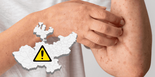 Le département de la santé de Jalisco confirme un nouveau cas de rougeole dans un lycée privé de Zapopan.